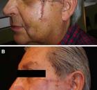 wynik leczenia żelem silikonowym po 4 tygodniach